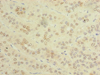 SPRYD5 Antibody - Immunohistochemistry of paraffin-embedded human liver cancer using TRIM51 Antibody at dilution of 1:100