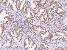 SPRYD5 Antibody - Immunochemical staining of human SPRYD5 in human gastric cancer with rabbit polyclonal antibody at 1:100 dilution, formalin-fixed paraffin embedded sections.