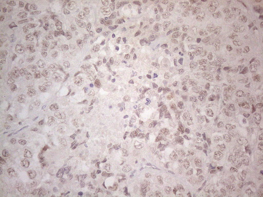 SPT3 / SUPT3H Antibody - Immunohistochemical staining of paraffin-embedded Adenocarcinoma of Human endometrium tissue using anti-SUPT3H mouse monoclonal antibody. (Heat-induced epitope retrieval by 1mM EDTA in 10mM Tris buffer. (pH8.5) at 120°C for 3 min. (1:150)