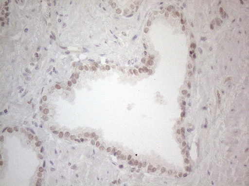 SPT3 / SUPT3H Antibody - Immunohistochemical staining of paraffin-embedded Carcinoma of Human prostate tissue using anti-SUPT3H mouse monoclonal antibody. (Heat-induced epitope retrieval by 1mM EDTA in 10mM Tris buffer. (pH8.5) at 120°C for 3 min. (1:150)
