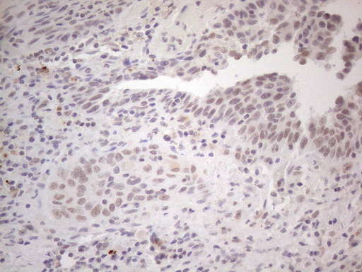 SPT3 / SUPT3H Antibody - Immunohistochemical staining of paraffin-embedded Carcinoma of Human bladder tissue using anti-SUPT3H mouse monoclonal antibody. (Heat-induced epitope retrieval by 1mM EDTA in 10mM Tris buffer. (pH8.5) at 120°C for 3 min. (1:150)