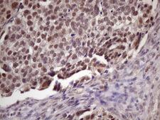 SPT3 / SUPT3H Antibody - Immunohistochemical staining of paraffin-embedded Adenocarcinoma of Human ovary tissue using anti-SUPT3H mouse monoclonal antibody. (Heat-induced epitope retrieval by 1 mM EDTA in 10mM Tris, pH8.5, 120C for 3min. (1:150)
