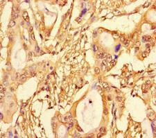 SPT3 / SUPT3H Antibody - Immunohistochemistry of paraffin-embedded human pancreatic cancer using SUPT3H Antibody at dilution of 1:100