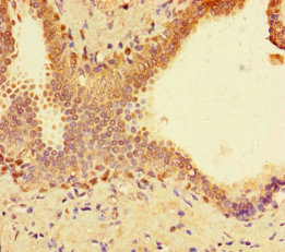 SPT3 / SUPT3H Antibody - Immunohistochemistry of paraffin-embedded human prostate cancer using SUPT3H Antibody at dilution of 1:100