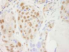 SPT5 / SUPT5H Antibody - Detection of Human SUPT5H by Immunohistochemistry. Sample: FFPE section of human breast adenocarcinoma. Antibody: Affinity purified rabbit anti-SUPT5H used at a dilution of 1:250.