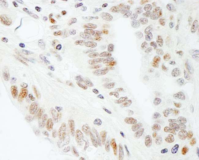 SPT5 / SUPT5H Antibody - Detection of Human SUPT5H by Immunohistochemistry. Sample: FFPE section of human ovarian carcinoma. Antibody: Affinity purified rabbit anti-SUPT5H used at a dilution of 1:1000 (1 ug/ml). Detection: DAB.
