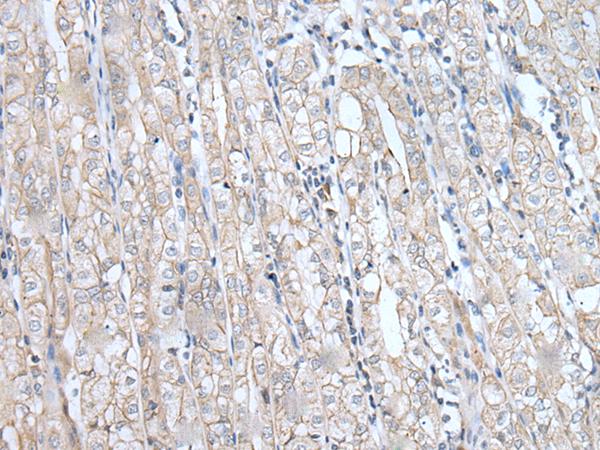 SPTA1 / Alpha Spectrin Antibody - Immunohistochemistry of paraffin-embedded Human gastric cancer tissue  using SPTA1 Polyclonal Antibody at dilution of 1:80(×200)