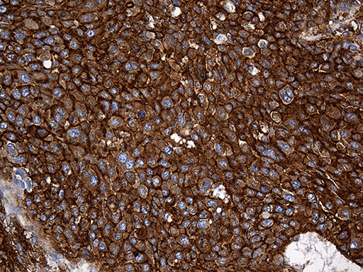 SPTAN1 / Alpha Fodrin Antibody - Immunohistochemical staining of paraffin-embedded Carcinoma of Human liver tissue using anti-SPTAN1 mouse monoclonal antibody. (Heat-induced epitope retrieval by 1mM EDTA in 10mM Tris buffer. (pH8.5) at 120°C for 3 min. (1:2000)