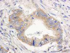 SPTAN1 / Alpha Fodrin Antibody - Detection of Human SPTAN1/Alpha II-Spectrin by Immunohistochemistry. Sample: FFPE section of human colon carcinoma. Antibody: Affinity purified rabbit anti-SPTAN1/Alpha II-Spectrin used at a dilution of 1:1000 (1 ug/ml). Detection: DAB.