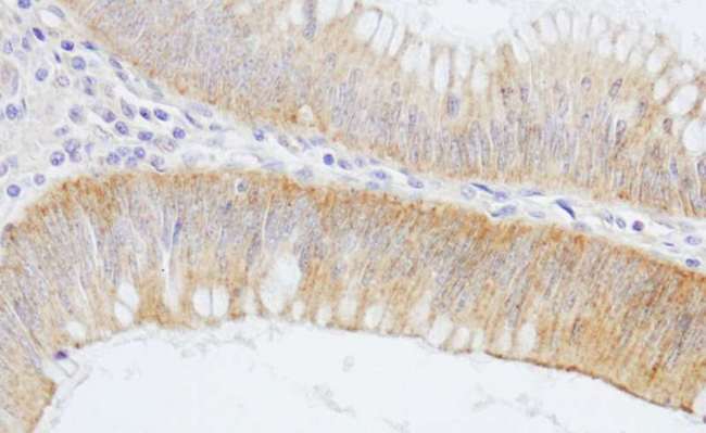 SPTAN1 / Alpha Fodrin Antibody - Detection of Human SPTAN1/Alpha II-Spectrin by Immunohistochemistry. Sample: FFPE section of human colon carcinoma. Antibody: Affinity purified rabbit anti-SPTAN1/Alpha II-Spectrin used at a dilution of 1:200 (1 ug/ml). Detection: DAB.