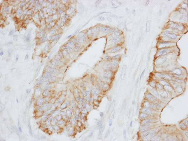 SPTBN1 / ELF Antibody - Detection of Human SPTBN1 by Immunohistochemistry. Sample: FFPE section of human colon carcinoma. Antibody: Affinity purified rabbit anti-SPTBN1 used at a dilution of 1:1000 (0.2 ug/ml). Detection: DAB.