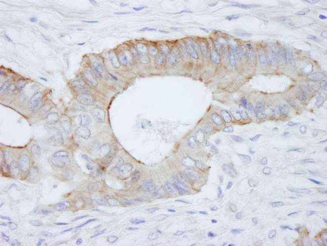 SPTBN1 / ELF Antibody - Detection of Human SPTBN1 by Immunohistochemistry. Sample: FFPE section of human colon adenocarcinoma. Antibody: Affinity purified rabbit anti-SPTBN1 used at a dilution of 1:250.
