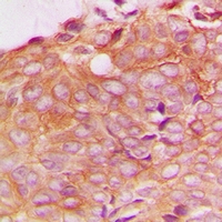 SPTBN1 / ELF Antibody - Immunohistochemical analysis of SPTBN1 staining in human breast cancer formalin fixed paraffin embedded tissue section. The section was pre-treated using heat mediated antigen retrieval with sodium citrate buffer (pH 6.0). The section was then incubated with the antibody at room temperature and detected with HRP and DAB as chromogen. The section was then counterstained with hematoxylin and mounted with DPX.