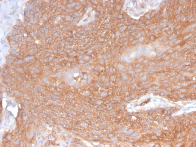 SPTBN2 Antibody - Formalin-fixed, paraffin-embedded human Pancreatic Cancer stained with Spectrin beta III Rabbit Recombinant Monoclonal (SPTBN2/2894R).