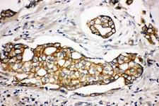SPTLC1 / HSN1 Antibody - SPTLC1 / HSN1 antibody. IHC(P): Human Breast Cancer Tissue.
