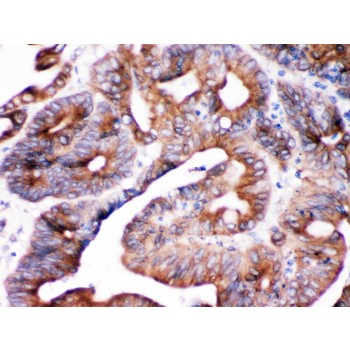 SPTLC1 / HSN1 Antibody - SPTLC1 was detected in paraffin-embedded sections of human intestinal cancer tissues using rabbit anti- SPTLC1 Antigen Affinity purified polyclonal antibody at 1 ug/mL. The immunohistochemical section was developed using SABC method.