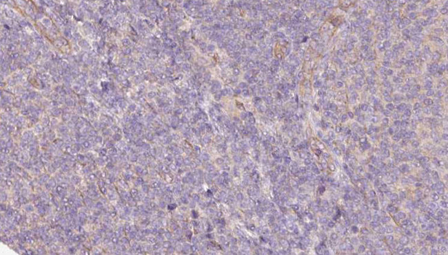 SPTLC2 / LCB2 Antibody - 1:100 staining human lymph carcinoma tissue by IHC-P. The sample was formaldehyde fixed and a heat mediated antigen retrieval step in citrate buffer was performed. The sample was then blocked and incubated with the antibody for 1.5 hours at 22°C. An HRP conjugated goat anti-rabbit antibody was used as the secondary.