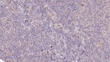 SPTLC2 / LCB2 Antibody - 1:100 staining human lymph carcinoma tissue by IHC-P. The sample was formaldehyde fixed and a heat mediated antigen retrieval step in citrate buffer was performed. The sample was then blocked and incubated with the antibody for 1.5 hours at 22°C. An HRP conjugated goat anti-rabbit antibody was used as the secondary.