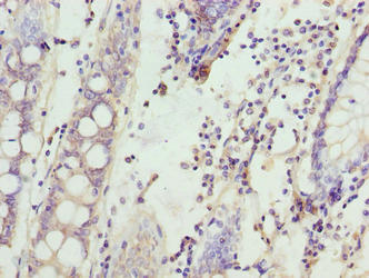 SPTLC3 / C20orf38 Antibody - Immunohistochemistry of paraffin-embedded human colon cancer using SPTLC3 Antibody at dilution of 1:100