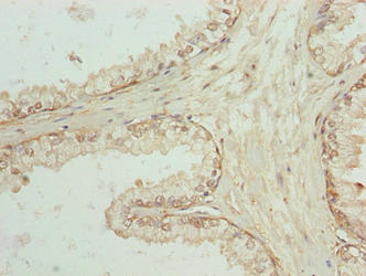 SPTLC3 / C20orf38 Antibody - Immunohistochemistry of paraffin-embedded human prostate cancer using SPTLC3 Antibody at dilution of 1:100