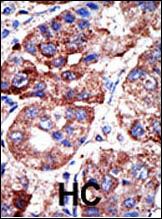 SQSTM1 Antibody - Formalin-fixed and paraffin-embedded human cancer tissue reacted with the primary antibody, which was peroxidase-conjugated to the secondary antibody, followed by DAB staining. This data demonstrates the use of this antibody for immunohistochemistry; clinical relevance has not been evaluated. BC = breast carcinoma; HC = hepatocarcinoma.
