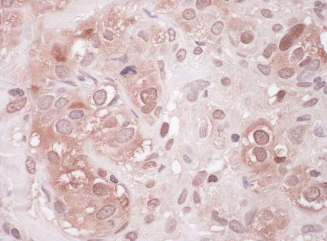 SQSTM1 Antibody - Detection of Human Sequestosome-1 by Immunohistochemistry. Sample: FFPE section of human breast carcinoma. Antibody: Affinity purified rabbit anti-Sequestosome-1 used at a dilution of 1:200 (1 ug/ml). Detection: Vector Laboratories ImmPACT NovaRED Peroxidase Substrate.