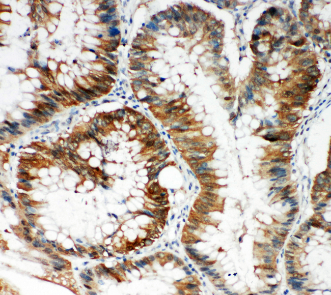 SQSTM1 Antibody - P62 / SQSTM1 antibody. IHC(P): Human Intestinal Cancer Tissue.
