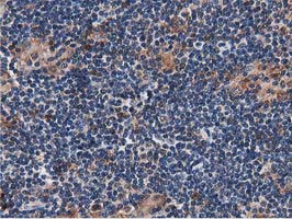 SQSTM1 Antibody - IHC of paraffin-embedded Human lymphoma tissue using anti-SQSTM1 mouse monoclonal antibody. (Heat-induced epitope retrieval by 10mM citric buffer, pH6.0, 100C for 10min).