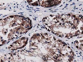 SQSTM1 Antibody - IHC of paraffin-embedded Adenocarcinoma of Human ovary tissue using anti-SQSTM1 mouse monoclonal antibody.