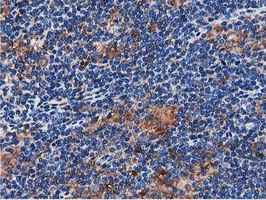 SQSTM1 Antibody - IHC of paraffin-embedded Human lymphoma tissue using anti-SQSTM1 mouse monoclonal antibody.