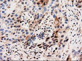 SQSTM1 Antibody - IHC of paraffin-embedded Carcinoma of Human bladder tissue using anti-SQSTM1 mouse monoclonal antibody. (Heat-induced epitope retrieval by 10mM citric buffer, pH6.0, 100C for 10min).