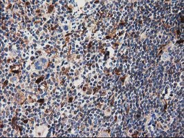 SQSTM1 Antibody - IHC of paraffin-embedded Human lymphoma tissue using anti-SQSTM1 mouse monoclonal antibody. (Heat-induced epitope retrieval by 10mM citric buffer, pH6.0, 100C for 10min).