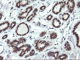 SQSTM1 Antibody - IHC of paraffin-embedded Carcinoma of Human thyroid tissue using anti-SQSTM1 mouse monoclonal antibody. (Heat-induced epitope retrieval by 10mM citric buffer, pH6.0, 100C for 10min).