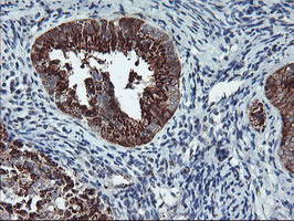 SQSTM1 Antibody - IHC of paraffin-embedded Adenocarcinoma of Human endometrium tissue using anti-SQSTM1 mouse monoclonal antibody. (Heat-induced epitope retrieval by 10mM citric buffer, pH6.0, 100C for 10min).