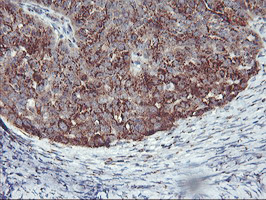 SQSTM1 Antibody - IHC of paraffin-embedded Adenocarcinoma of Human ovary tissue using anti-SQSTM1 mouse monoclonal antibody. (Heat-induced epitope retrieval by 10mM citric buffer, pH6.0, 100C for 10min).