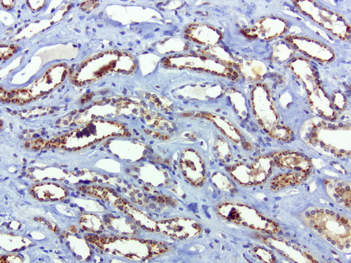 SQSTM1 Antibody - Immunohistochemical staining of paraffin-embedded human kidney using anti-SQSTM1 clone UMAB12 mouse monoclonal antibody  at 1:100 with Polink2 Broad HRP DAB detection kit; heat-induced epitope retrieval with GBI Accel pH 8.7 HIER buffer using pressure chamber for 3 minutes at 110C. Strong cytoplasmic staining is seen in the tubule epithelial cells.