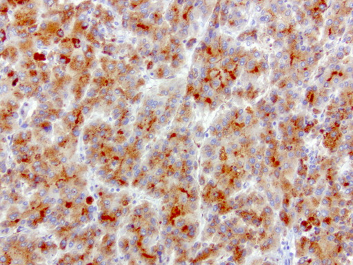 SQSTM1 Antibody - Immunohistochemical staining of paraffin-embedded human liver cancer using anti-SQSTM1 clone UMAB12 mouse monoclonal antibody  at 1:100 with Polink2 Broad HRP DAB detection kit; heat-induced epitope retrieval with GBI Accel pH 8.7 HIER buffer using pressure chamber for 3 minutes at 110C. Strong cytoplasmic staining is seen in the tumor cells.