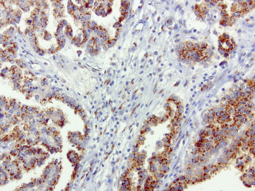 SQSTM1 Antibody - Immunohistochemical staining of paraffin-embedded human ovarian cancer using anti-SQSTM1 clone UMAB12 mouse monoclonal antibody  at 1:100 with Polink2 Broad HRP DAB detection kit; heat-induced epitope retrieval with GBI Accel pH 8.7 HIER buffer using pressure chamber for 3 minutes at 110C. Strong cytoplasmic staining is seen in the tumor cells.