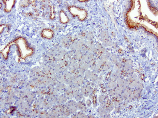 SQSTM1 Antibody - Immunohistochemical staining of paraffin-embedded human pancreatic cancer using anti-SQSTM1 clone UMAB12 mouse monoclonal antibody  at 1:100 with Polink2 Broad HRP DAB detection kit; heat-induced epitope retrieval with GBI Accel pH 8.7 HIER buffer using pressure chamber for 3 minutes at 110C. Reduced cytoplasmic staining is seen in the tumor cells.