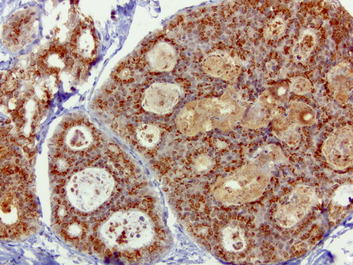 SQSTM1 Antibody - Immunohistochemical staining of paraffin-embedded human breast cancer using anti-SQSTM1 clone UMAB12 mouse monoclonal antibody  at 1:100 with Polink2 Broad HRP DAB detection kit; heat-induced epitope retrieval with GBI Accel pH 8.7 HIER buffer using pressure chamber for 3 minutes at 110C. Strong cytoplasmic staining is seen in the tumor cells.