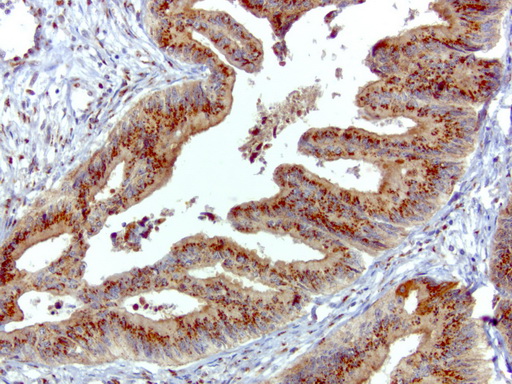 SQSTM1 Antibody - Immunohistochemical staining of paraffin-embedded human colon cancer using anti-SQSTM1 clone UMAB12 mouse monoclonal antibody  at 1:100 with Polink2 Broad HRP DAB detection kit; heat-induced epitope retrieval with GBI Accel pH 8.7 HIER buffer using pressure chamber for 3 minutes at 110C. Strong cytoplasmic staining is seen in the tumor cells.