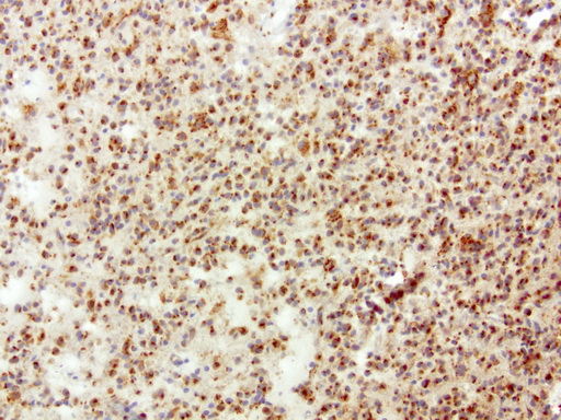 SQSTM1 Antibody - Immunohistochemical staining of paraffin-embedded human glioma using anti-SQSTM1 clone UMAB12 mouse monoclonal antibody  at 1:100 with Polink2 Broad HRP DAB detection kit; heat-induced epitope retrieval with GBI Accel pH 8.7 HIER buffer using pressure chamber for 3 minutes at 110C. Strong cytoplasmic staining is seen in the tumor cells.