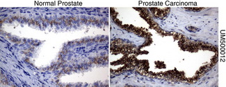 SQSTM1 Antibody - Immunohistochemical staining of paraffin-embedded prostate tissue using anti-SQSTM1mouse monoclonal antibody. (Clone UMAB12, dilution 1:100; heat-induced epitope retrieval by 10mM citric buffer, pH6.0, 120C for 3min)