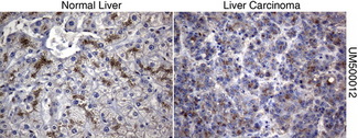 SQSTM1 Antibody - Immunohistochemical staining of paraffin-embedded liver tissue using anti-SQSTM1mouse monoclonal antibody. (Clone UMAB12, dilution 1:100; heat-induced epitope retrieval by 10mM citric buffer, pH6.0, 120C for 3min)