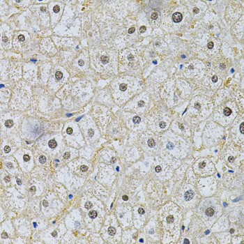 SQSTM1 Antibody - Immunohistochemistry of paraffin-embedded human liver injury using SQSTM1 Antibody at dilution of 1:200 (40x lens).