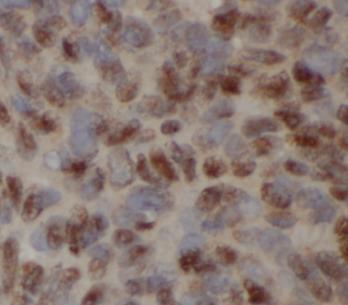 SQSTM1 Antibody - Immunohistochemistry of paraffin-embedded human liver cancer tissue slide using P62 SQSTM1 antibody at dilution of 1:100