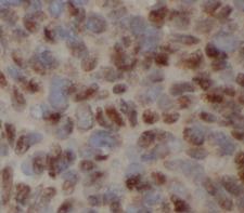 SQSTM1 Antibody - Immunohistochemistry of paraffin-embedded human liver cancer tissue slide using P62 SQSTM1 antibody at dilution of 1:100