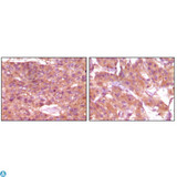 SRA1 / SRA Antibody - Immunohistochemistry (IHC) analysis of paraffin-embedded Human Skin carcinoma (left) and breast carcinoma (right), showing cytoplasmic and membrane localization with DAB staining using SRA1 Monoclonal Antibody.
