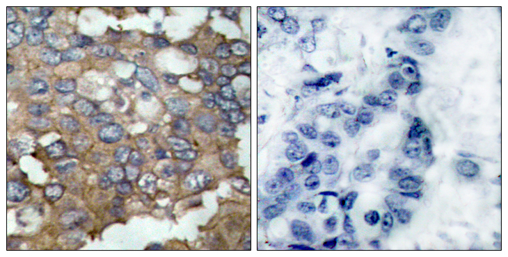 SRC Antibody - Immunohistochemistry analysis of paraffin-embedded human breast carcinoma tissue, using Src Antibody. The picture on the right is blocked with the synthesized peptide.