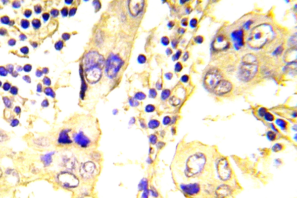 SRC Antibody - IHC of SRC (N535) pAb in paraffin-embedded human breast carcinoma tissue.